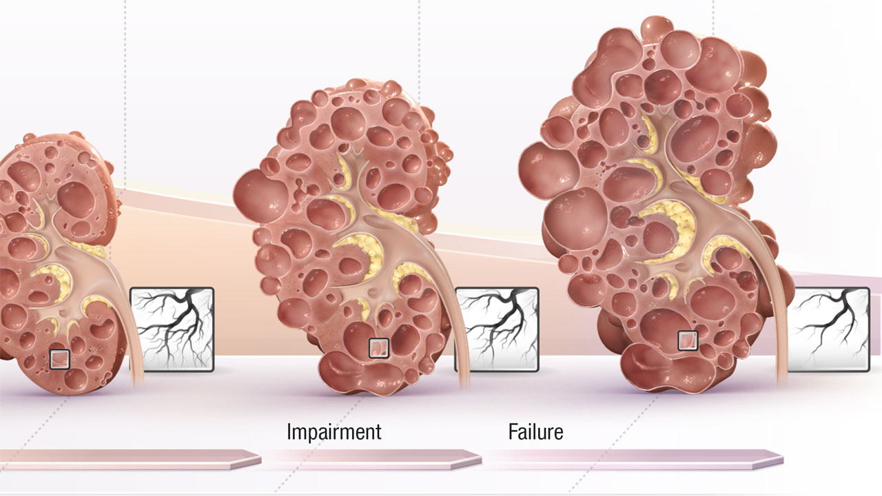 Kidney Disease Progression in ADPKD | Medical Animation | Scientific  Animation | AXS Studio