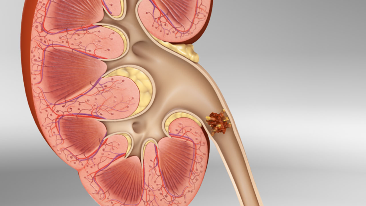 Inside Kidney Stone Disease Animation | Medical Animation | Scientific  Animation | AXS Studio