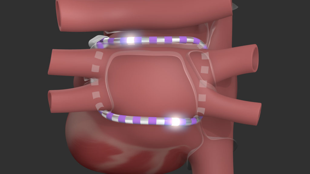 axs-studio-medical-device-animation-cardiac-ablation-03