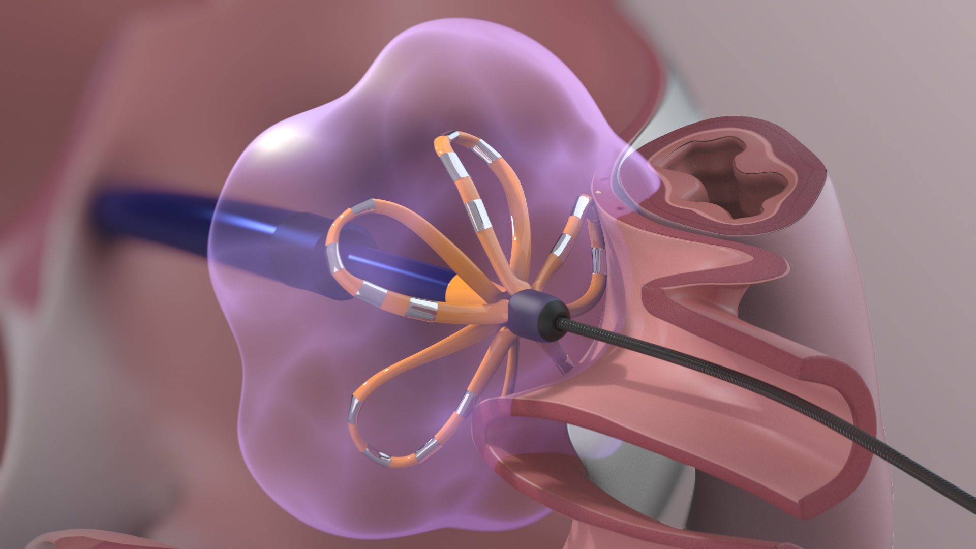 atrial fibrillation animation