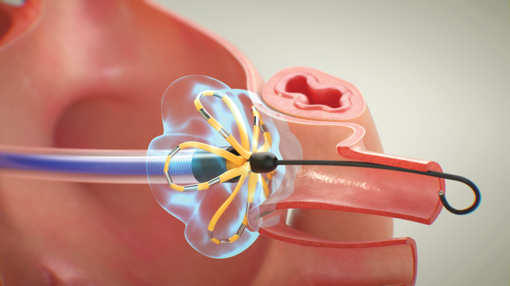 AXS Studio medical device animation of Farapulse pulsed field ablation, PFA, system ablating a pulmonary vein to treat atrial fibrillation, or AF.