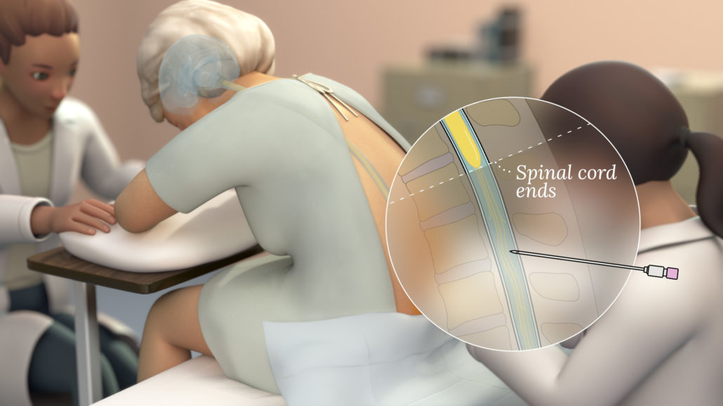 An elderly woman undergoes a lumbar puncture procedure. She is comforted by a nurse while a physician inserts the catheter into her lumbar spine. A callout shows a detail of the catheter entering the subdural space.