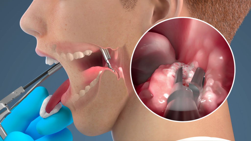 Demonstration of the Inova 1 Endoscopy System flexible scope mounted on the curved biopsy forceps. A surgeon's hand positions the forceps over the back of the tongue, on the side to take a biopsy from a suspected tumor. The surgeon's other hand grasps the patient's tongue. The inset shows the scope view of the forceps closing on the lesion. 