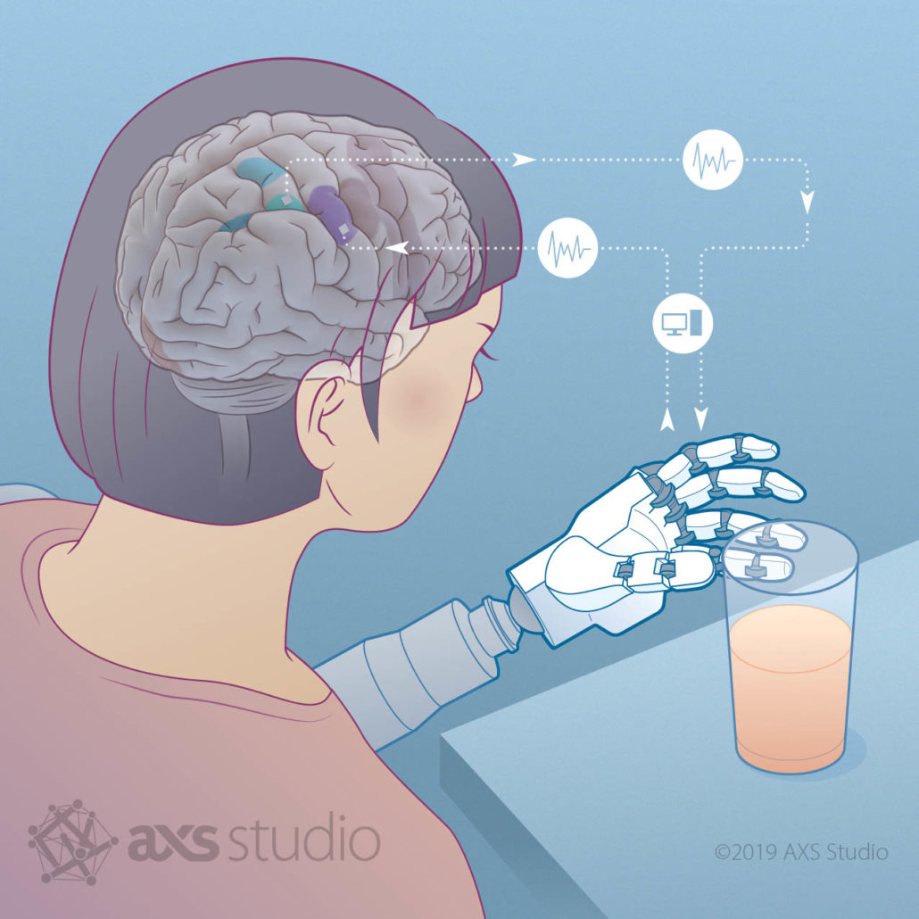 Illustration of Brain-Machine Interface (BMI) showing how visually-guided limb movements start with sensory information from the visual cortex. This informs one’s intentions or plans to make movements generated in the posterior parietal cortex (PCC). These signals are translated into motor responses that then would travel via the spinal cord to the limb. But in individuals with spinal cord injury or disease, signals can be read at the level of the cortex via an array implant in the PCC and recorded, decoded, and used to control a robotic limb (prosthesis). The sensors in the robot hand are sent back to stimulate a separate array, implanted in the somatosensory cortex. There is a closed loop from motor commands to somatosensory feedback and the feedback can be used to improve dexterous movement. Robot hand drawing was based on model licensed from Lucas Lin. Please note, final text / copy is copyright Sci Am. Image is copyright AXS.