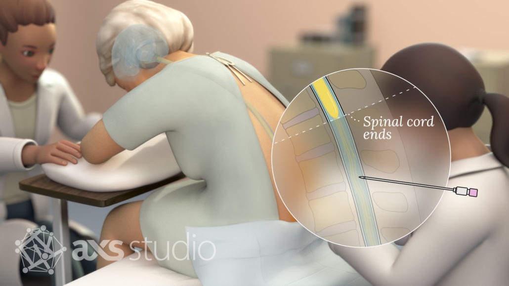 Patient education video for Alzheimer's patients and caregivers to inspire and encourage participation in AD research through donation of CSF.