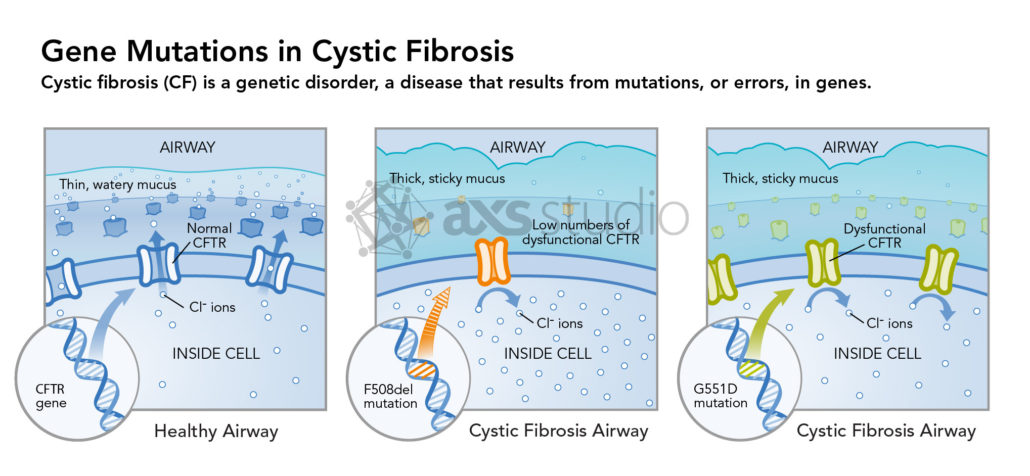 Gene mutations in cystic fibrosis: F508del mutation results in low numbers and dysfunctional CFTR receptors. G551D mutation results in dysfunctional CFTR receptors.