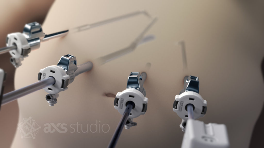A still from the INS001A Bariatric Surgery Animation, which shows four types of surgical procedures that are performed using the Da Vinci Surgical System. This still is a closeup shot of a patient with 4 laparoscopic instruments inserted through cannulas.