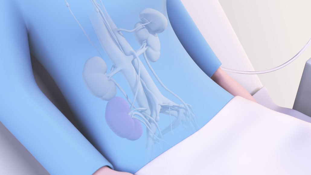 A stylized character lying in a hospital bed post-kidney transplant. Only her abdomen and arms are visible. Her abdomen is semi-transparent, revealing her kidneys, ureters, and related vasculature. Her original kidneys are shown in their natural position in her upper abdomen. A third, transplanded kidney (purple) is visible in her lower abdomen.