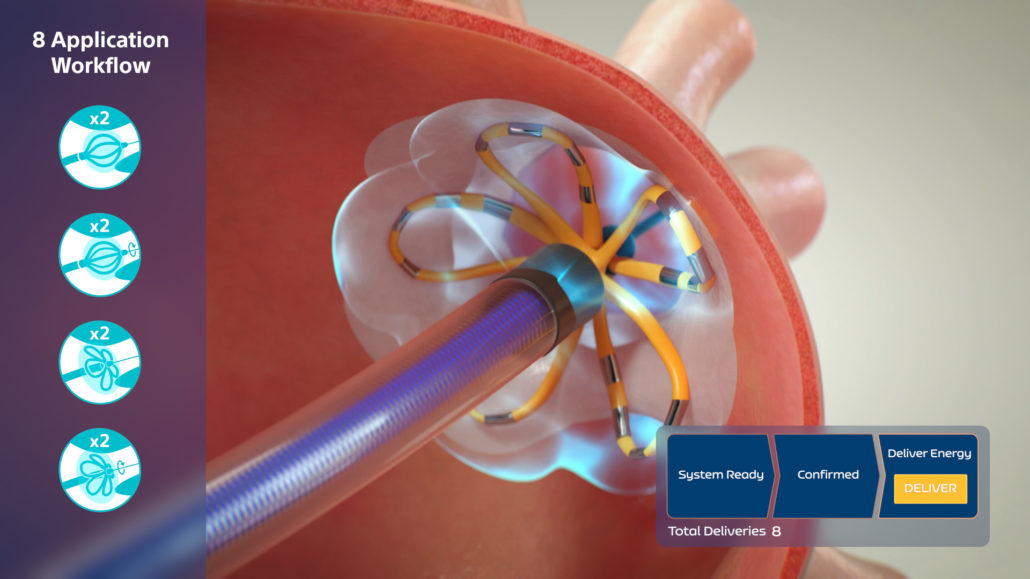 Still image from the 8-application Atrial Fibrillation (AF) ablation workflow with FARAWAVE catheter. Pulsed field ablation of left and right superior pulmonary vein (LSPV, RSPV, flower deployment, basket deployment).

A sectioned left atrium is visible with the FARAPULSE catheter emitting energy and changing the colour of the pulmonary vein ostium. User interface graphics indicate steps and progression in the ablation workflow.
