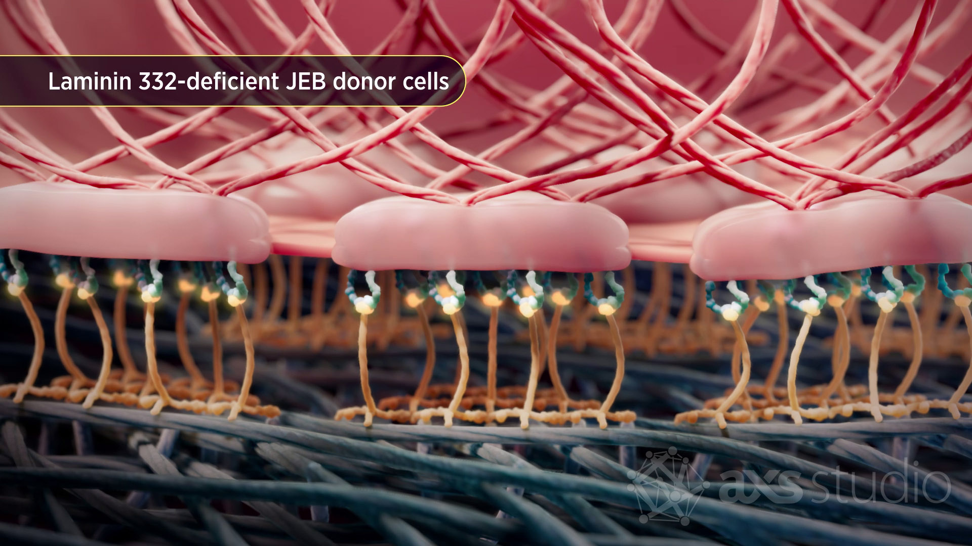 Section view of dermal-epidermal junction showing laminin-332 deficient hemidesomosomes from junctional epidermolysis bullosa donor cells. Intracelluar keratin fibers and extracelluar collagen fibers are visible. 
