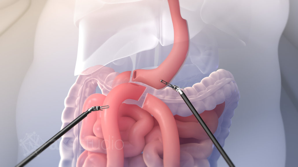 A still from the a patient education animation about bariatric surgery that depicts four types of bariatric or weight-loss surgeries that are performed using the da Vinci Surgical System. In this still from a scene that depicts biliopancreatic diversion with duodenal switch (BPD-DS) procedure, enterotomies can be seen in the duodenum and proximal ileum.